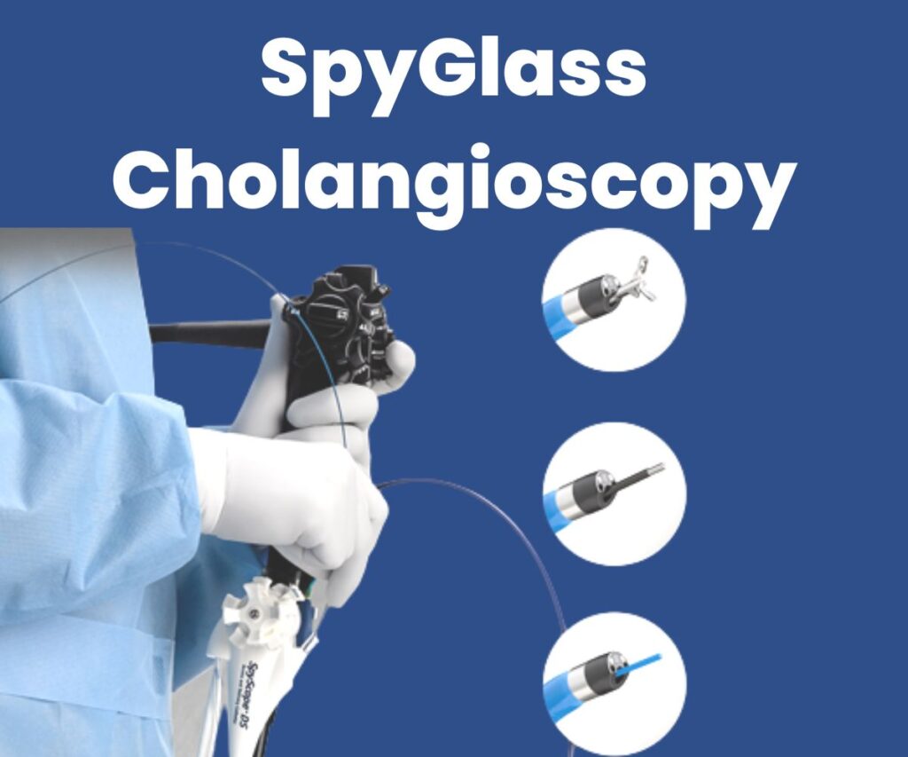 What Is Spyglass Cholangioscopy When Spyglass Cholangioscopy Is Done