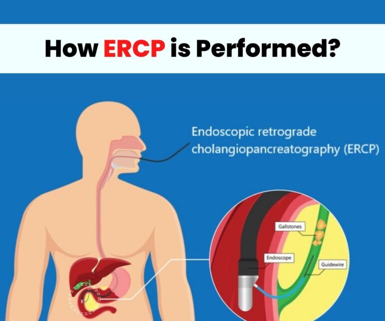 What Is Ercp And Mrcp at Wallace Burns blog